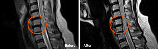 모커리한방병원 목디스크 MRI 전/후 사진 이미지